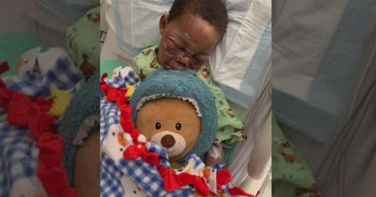 4-year-old mauled in dog attack in Detroit, suffering severe eye damage ...