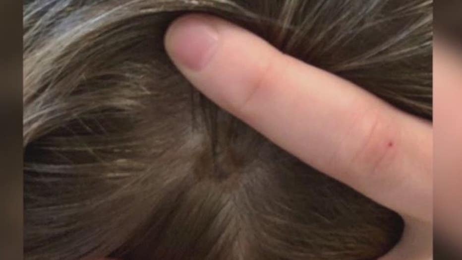 Caitlin Jones' mole in her hair part.