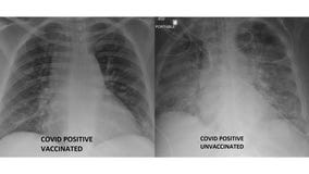 COVID-19 lung X-rays show difference between vaccinated, unvaccinated patients