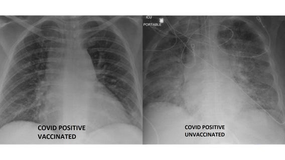 COVID-19 lung X-rays show difference between vaccinated, unvaccinated patients