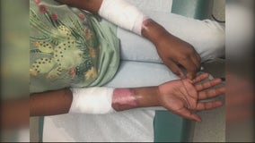 Family sues after Metro Detroit 4th grader burned by scalding water when teacher left kettle unattended