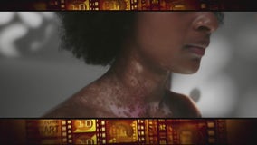 Lee Thomas reflects on World Vitiligo Day, narrates short film Shed Some Light