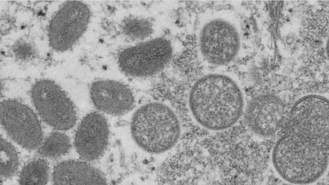 Doctor explains monkeypox and risk of catching it after case likely found in state