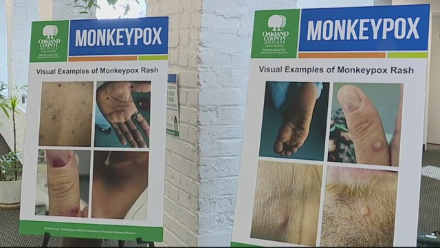 CDC: Monkeypox cases increase to 104 in Michigan