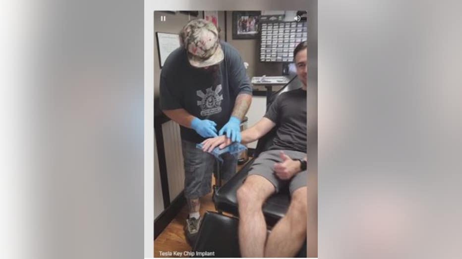 Brandon Dalaly, seen here during his chip implant surgery on his hand.