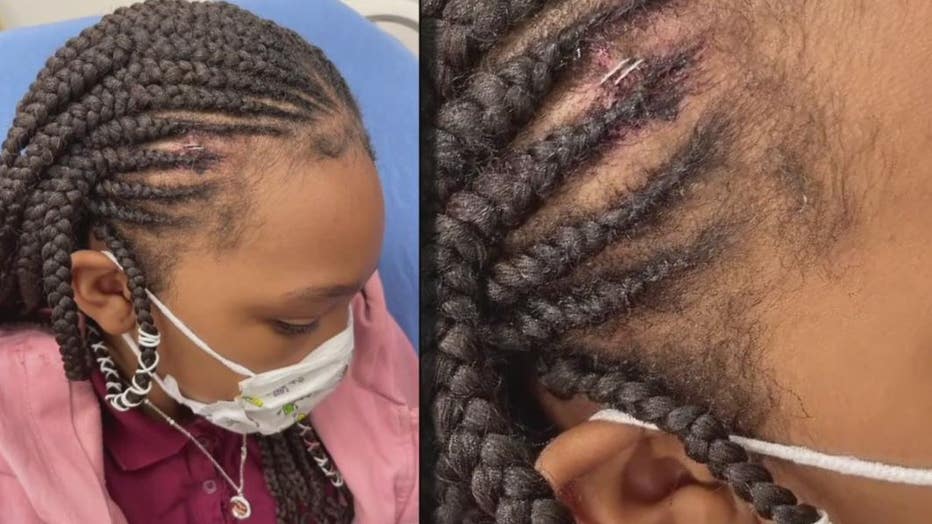 Eleven-year-old Cha'Kyra Thomas and the staples in her head after the injury.