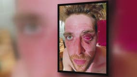 Man loses eye in alleged beating by Clinton Township officer, sues claiming excessive force