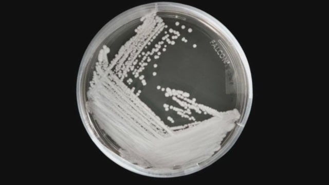 Fungal infection Candida auris on the rise, appears to be resistant to most drugs