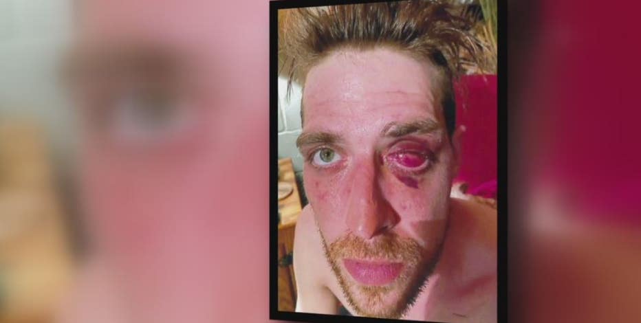 Man who lost eye awarded $4M verdict after suing Clinton Township officer who punched him in face