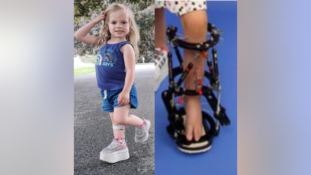 Family holding fundraiser for four-year-old with Fibular Hemimelia