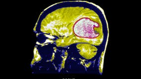 Scientists use new strategy to successfully shrink tumors in early brain cancer trials