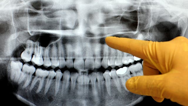 Michigan dentists dropping lead aprons during patient x-rays