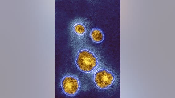 Mumps in Oakland County: Health officials confirm county's first case