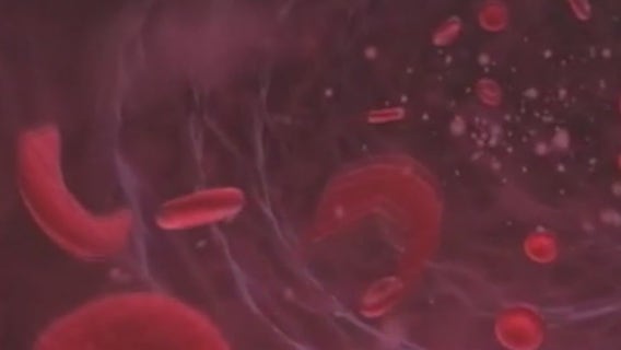 Metro Detroit advocate for sickle cell patients worry about potential Trump cuts