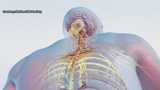 Living with MS can feel isolating - but it doesn't have to be