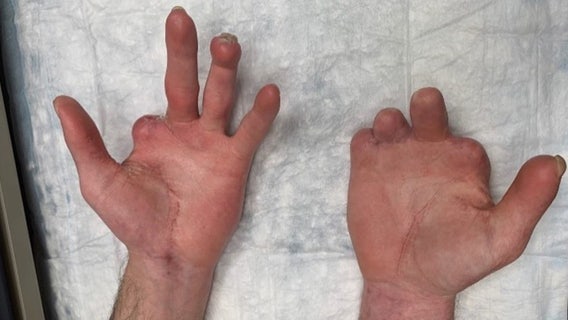 Kroger ordered to pay $75M+ to man who lost part of hands while working at Michigan store