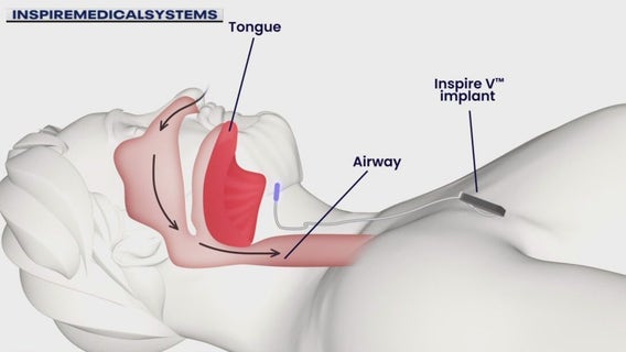 Sleep apnea implant can solve night time rest instead of a CPAP mask