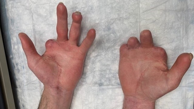 Kroger ordered to pay $75M+ to man who lost part of hands while working at Michigan store