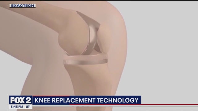 Augmented reality tech used with new knee replacement technique