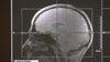Exercise and Wordle are great ways to reduce dementia risk
