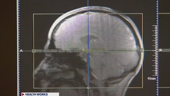 Exercise and Wordle are great ways to reduce dementia risk