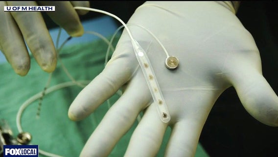 Brain computer chips tested at U-M Health provide possible medical breakthrough