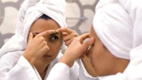 Dermatologist's advice for teen acne - start simple treatments (and don't pop them!)
