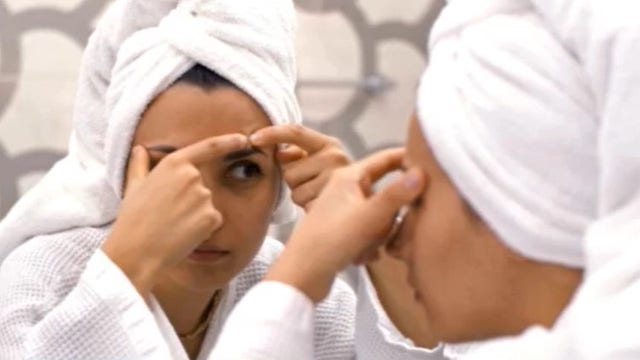 Dermatologist's advice for teen acne - start simple treatments (and don't pop them!)