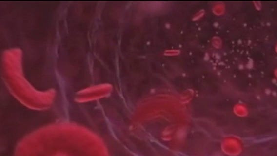 Sickle Cell disease treatment hits medical breakthrough in Detroit