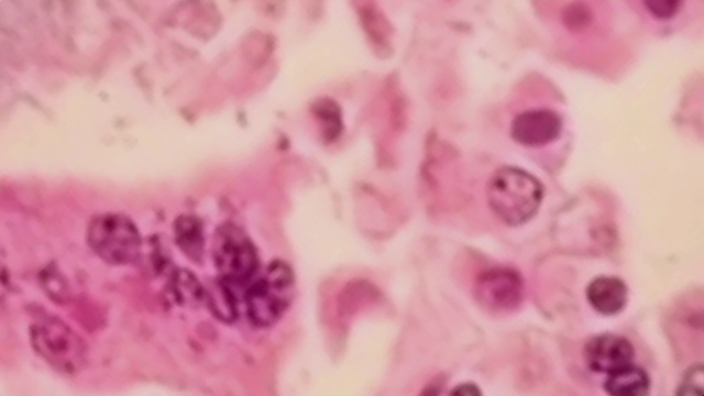 Measles case reported in Chicago area after person infected travels to several locations