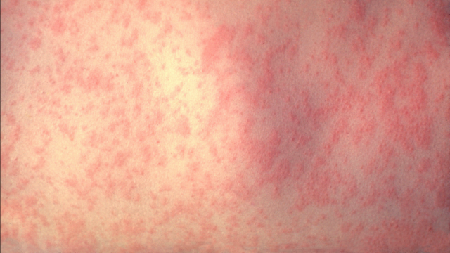 Illinois health department responding to US measles outbreak