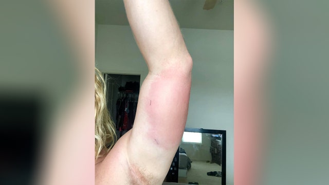 Man contracts flesh-eating bacteria while going about ‘an average day,' not entering water