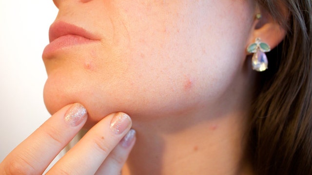 Researchers may have come up with acne vaccine