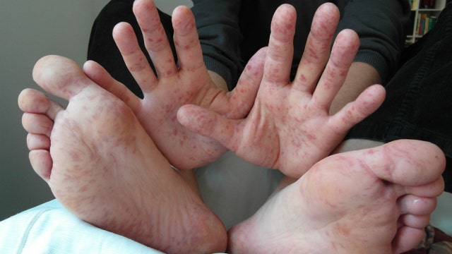 It's peak season for hand, foot and mouth disease