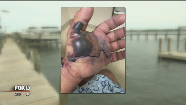 Flesh-eating bacteria nearly kills man who was fishing