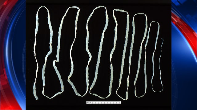 Medical report: 18-year-old dead after tapeworm infestation and infection in the brain