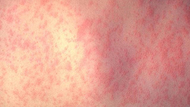 Officials warn of potential measles exposure at Loop restaurant