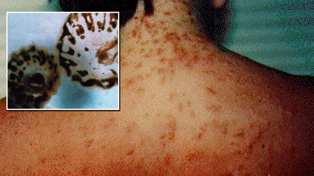 Sea lice warning posted for Florida Panhandle beaches