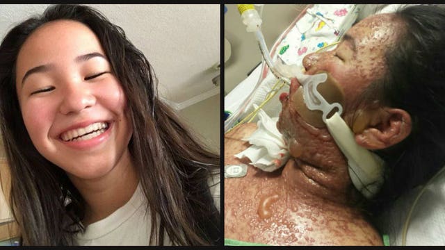 LA teenager's skin 'melts' off in severe reaction to prescription medication with strict FDA warning