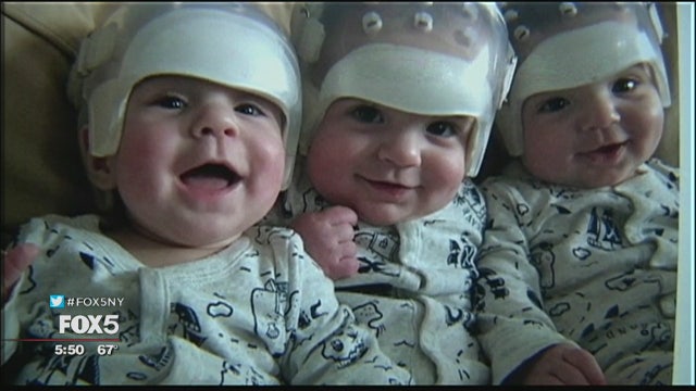 Triplets undergo skull surgery
