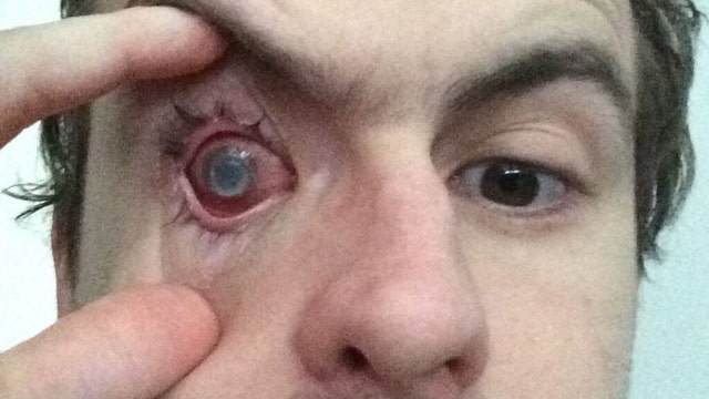Man goes blind in right eye after contracting parasitic infection from showering in contacts