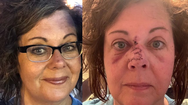 Woman's 'innocent-looking freckle' turns out to be melanoma
