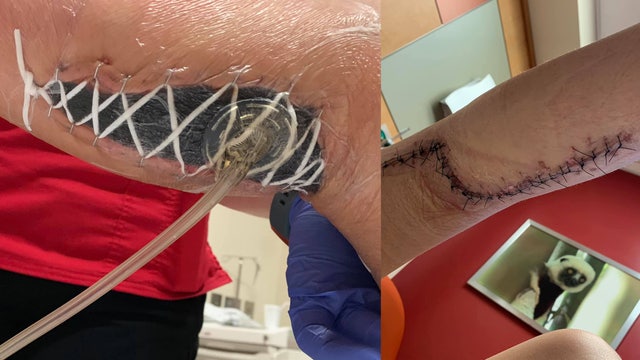 Mom says girl developed deadly ‘flesh-eating' bacteria while visiting popular beach