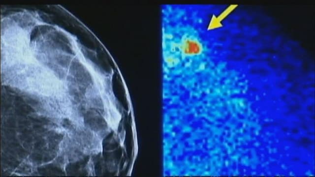 Experimental therapy uses immune system to fight breast cancer