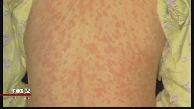 Second measles case reported in Chicago area