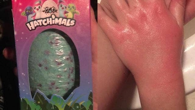 Mom claims Hatchimals bath bomb gave daughter chemical burns