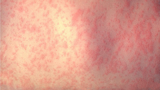 WARNING: Potential measles exposure at Midway Airport, suburban hospital