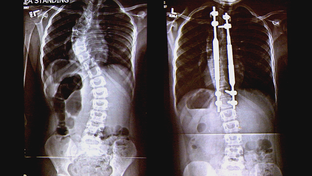 Magnetic rods help young scoliosis patient avoid surgery