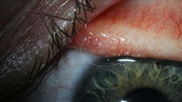 14 worms pulled from woman's eye after rare infection