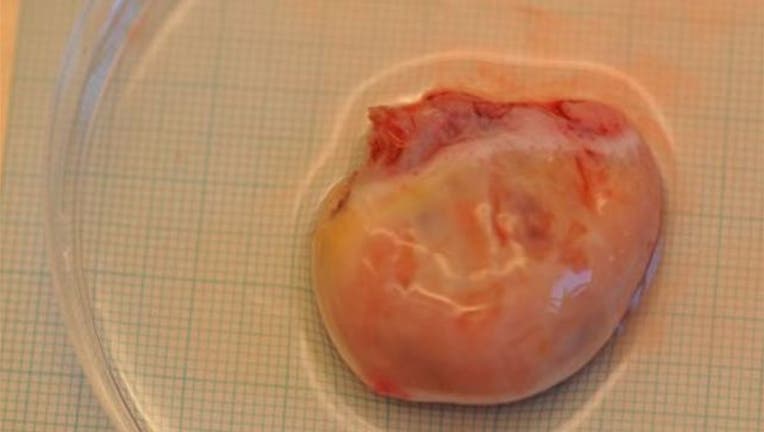 afaae4c1-Ovary_Transplants_ap_1444228137031.jpg